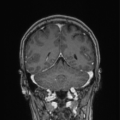 Cerebral abscess from pulmonary arteriovenous malformation (Radiopaedia 86275-102291 L 30).png
