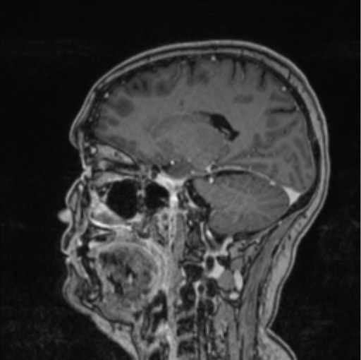Cerebral abscess from pulmonary arteriovenous malformation (Radiopaedia 86275-102291 Sagittal T1 C+ 32).png