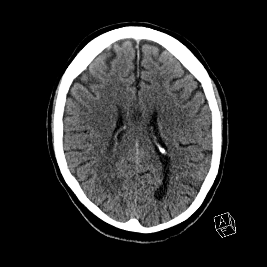 Cerebral abscess with ventriculitis (Radiopaedia 78965-91876 Axial non-contrast 31).jpg