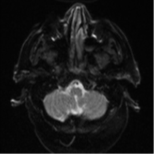 Cerebral abscesses- medically managed (Radiopaedia 45183-49179 Axial DWI 5).png