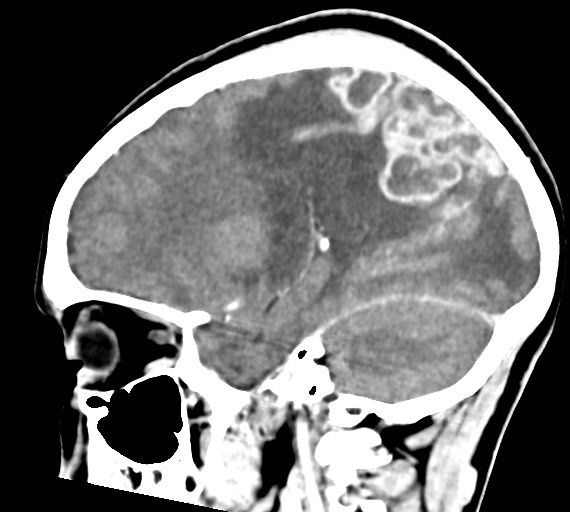 Cerebral abscesses (Radiopaedia 70458-80568 Sagittal Contrast 22).jpg