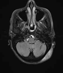 File:Cerebral amyloid angiopathy-related inflammation (Radiopaedia 74836-85849 Axial FLAIR 6).jpg