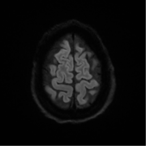 Cerebral amyloid angiopathy (Radiopaedia 46082-50433 Axial DWI 51).png