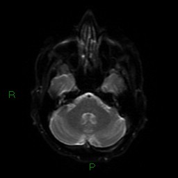 File:Cerebral amyloid angiopathy (Radiopaedia 77506-89664 Axial DWI 36).jpg
