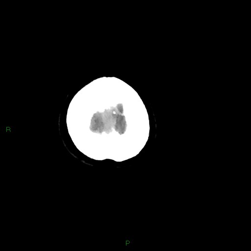 Cerebral amyloid angiopathy (Radiopaedia 77506-89665 Axial non-contrast 108).jpg