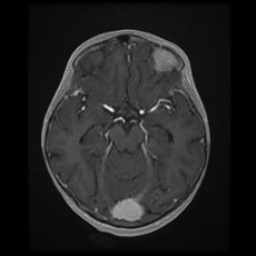 File:Cerebral and spinal tuberculosis (Radiopaedia 90489-107837 Axial T1 C+ 84).jpg