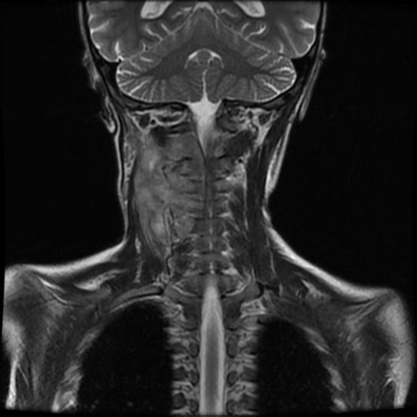 File:Cerebral and spinal tuberculosis (Radiopaedia 90489-107838 Coronal 6).jpg