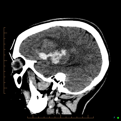 Cerebral arteriovenous malformation (AVM) (Radiopaedia 78162-90706 A 21).jpg