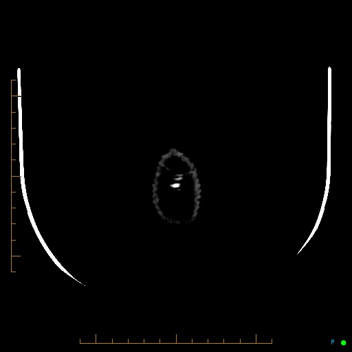 Cerebral arteriovenous malformation (AVM) (Radiopaedia 78162-90706 Axial non-contrast 66).jpg