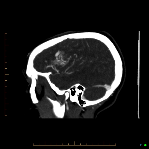 Cerebral arteriovenous malformation (AVM) (Radiopaedia 78162-90706 Sagittal CTA 19).jpg