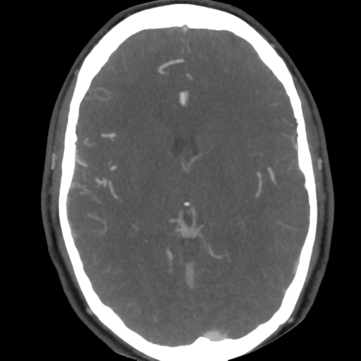Cerebral arteriovenous malformation (Radiopaedia 39259-41505 AX CEREBRAL CTA 30).png