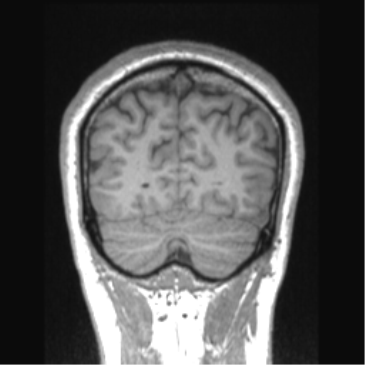 File:Cerebral arteriovenous malformation (Radiopaedia 39259-41506 Coronal T1 20).png