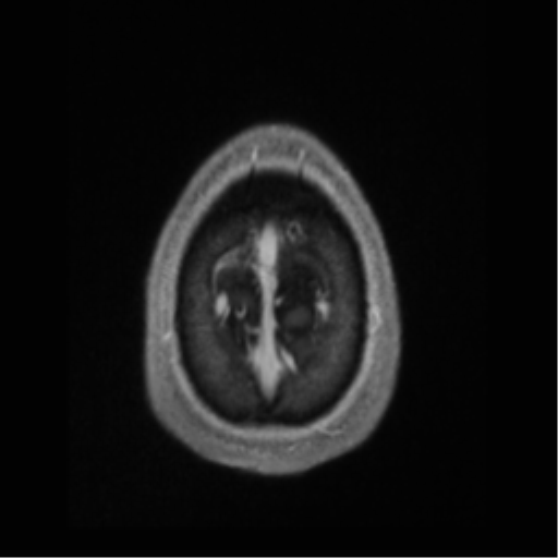Cerebral arteriovenous malformation (Radiopaedia 55798-62372 Axial T1 C+ 73).png