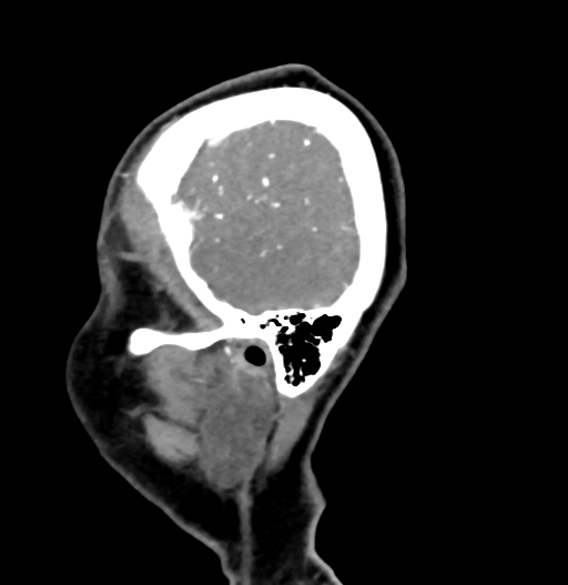 Cerebral arteriovenous malformation (Radiopaedia 73830-84645 D 83).jpg