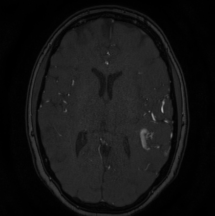 Cerebral arteriovenous malformation (Radiopaedia 74411-85654 Axial MRA 83).jpg