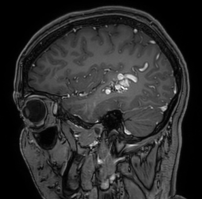 Cerebral arteriovenous malformation (Radiopaedia 74411-85654 Sagittal T1 C+ 30).jpg