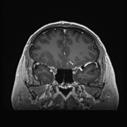 Cerebral arteriovenous malformation (Radiopaedia 84015-99245 Coronal T1 C+ 51).jpg