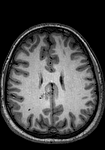 Cerebral arteriovenous malformation at posterior body of corpus callosum (Radiopaedia 74111-84925 Axial T1 95).jpg
