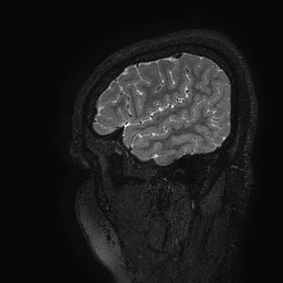 Cerebral arteriovenous malformation at posterior body of corpus callosum (Radiopaedia 74111-84925 Sagittal T2 122).jpg