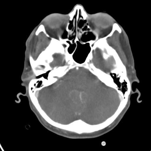 Cerebral arteriovenous malformation with hemorrhage (Radiopaedia 28773-29073 A 41).jpg