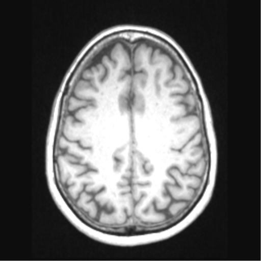 File:Cerebral arteriovenous malformation with hemorrhage (Radiopaedia 34422-35737 Axial T1 54).png