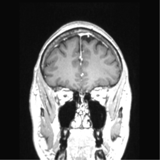 Cerebral arteriovenous malformation with hemorrhage (Radiopaedia 34422-35737 Coronal T1 C+ 71).png