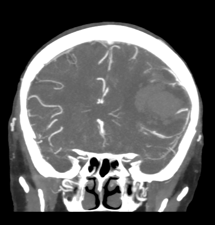 Cerebral arteriovenous malformation with lobar hemorrhage (Radiopaedia 44725-48511 B 20).png