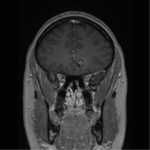 Cerebral cavernoma and development venous anomaly (Radiopaedia 37603-39482 Coronal T1 C+ 68).png