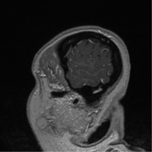 Cerebral cavernoma and development venous anomaly (Radiopaedia 37603-39482 Sagittal T1 C+ 84).png