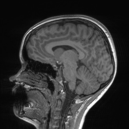 File:Cerebral cavernous venous malformation (Radiopaedia 70008-80021 Sagittal T1 34).jpg