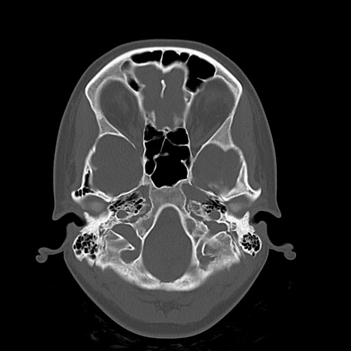 Cerebral cavernous venous malformation (Radiopaedia 70008-80022 Axial bone window 6).jpg