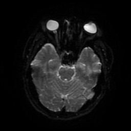 Cerebral cavernous venous malformation (Zabramski type II) (Radiopaedia 85511-101198 Axial DWI 78).jpg