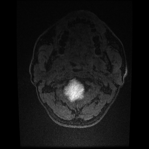 Cerebral cavernous venous malformation (Zabramski type II) (Radiopaedia 85511-101198 Axial T1 C+ fat sat 3).jpg