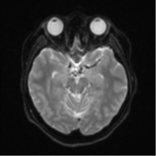 Cerebral cavernous venous malformations (Radiopaedia 48117-52946 Axial DWI 10).png