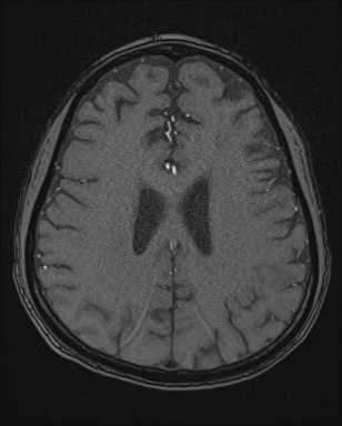 Cerebral embolic infarcts (embolic shower) (Radiopaedia 72391-82921 Axial MRA 135).jpg