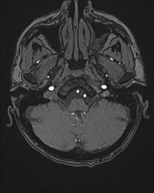 Cerebral embolic infarcts (embolic shower) (Radiopaedia 72391-82921 Axial MRA 7).jpg