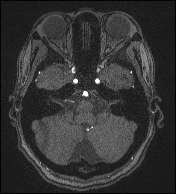 Cerebral fat embolism (Radiopaedia 35022-36525 Axial TOF 42).jpg