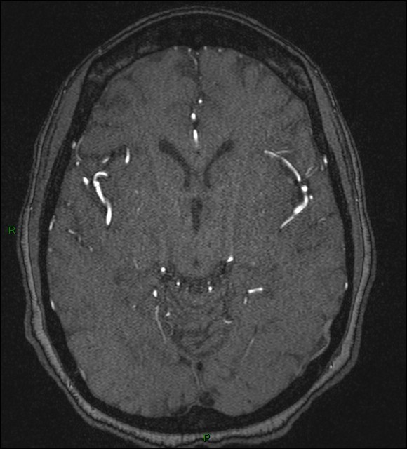 Cerebral fat embolism (Radiopaedia 35022-36525 Axial TOF 94).jpg