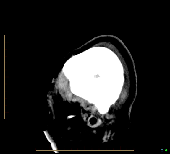 Cerebral fat embolism (Radiopaedia 85521-101224 C 4).jpg
