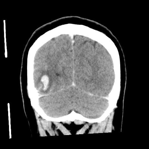 Cerebral hemorrhage secondary to arteriovenous malformation (Radiopaedia 33497-34561 C 54).png
