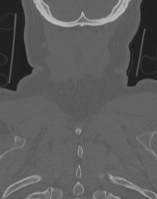 Cerebral hemorrhagic contusions and cervical spine fractures (Radiopaedia 32865-33841 Coronal bone window 72).jpg
