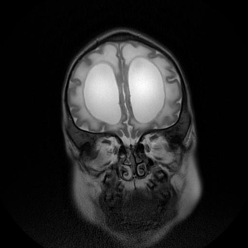 File:Cerebral manifestations of mucopolysaccharidosis type I (Radiopaedia 59171-66487 Coronal T2 3).jpg