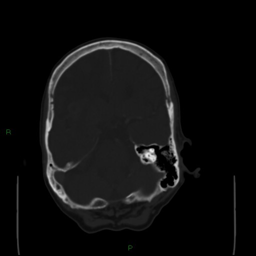Cerebral metastases - breast primary (Radiopaedia 77653-89857 Axial bone window 40).jpg