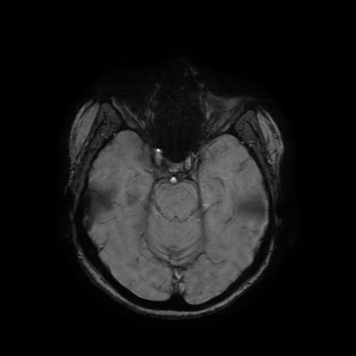 Cerebral metastases - melanoma (Radiopaedia 80972-94522 Axial SWI 35).jpg