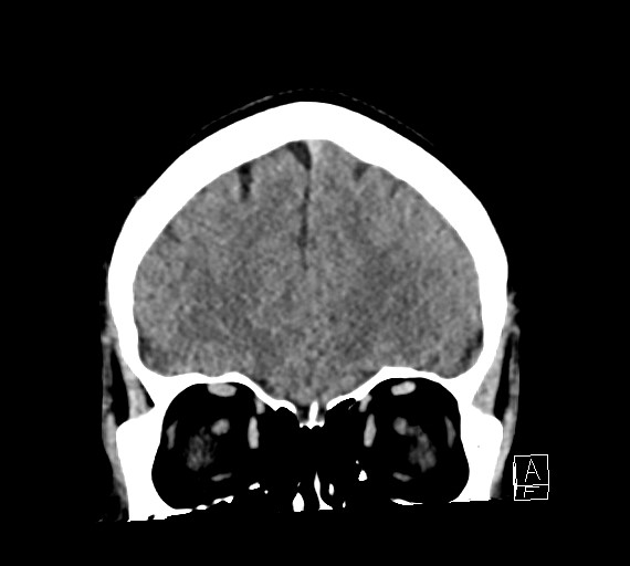 Cerebral metastases - testicular choriocarcinoma (Radiopaedia 84486-99855 Coronal C+ delayed 15).jpg