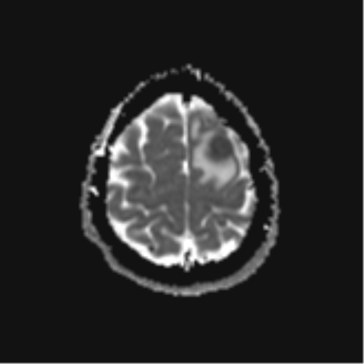File:Cerebral metastases mimicking abscesses (Radiopaedia 45841-50131 Axial ADC 25).png