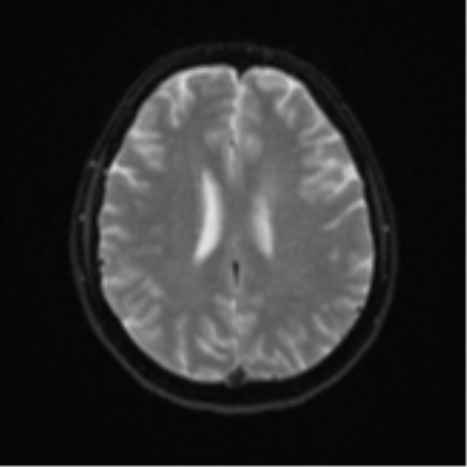 Cerebral metastases mimicking abscesses (Radiopaedia 45841-50131 Axial DWI 19).png