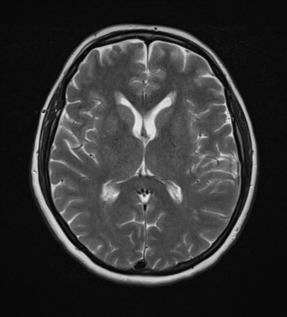 File:Cerebral metastases mimicking abscesses (Radiopaedia 45841-50131 Axial T2 16).png