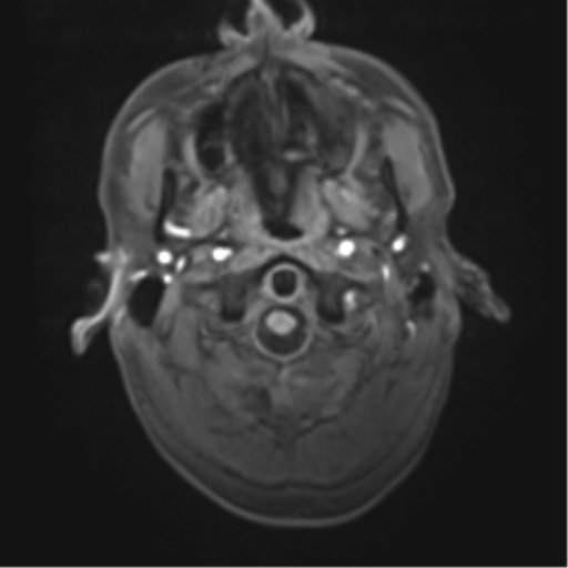 File:Cerebral metastasis - melanoma (Radiopaedia 54718-60954 Axial T1 3).png