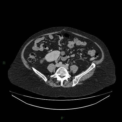 File:Cerebral metastasis from renal cell carcinoma (Radiopaedia 82306-96378 A 118).jpg